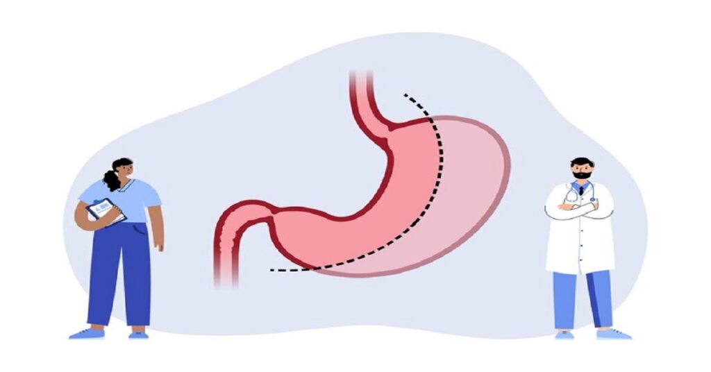 gastric sleeve operation in indore,gastric sleeve surgery in indore, best gastric sleeve surgery in indore, gastric sleeve surgery indore,