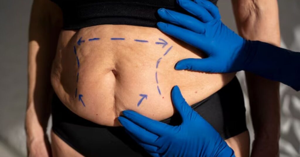 best obesity surgery in Indore